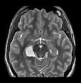 Hippocampal Choroidal Fissure Arachnoid Cyst