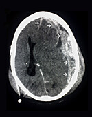 Brain, Subdural Haemorrhage, CT Scan