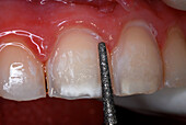 Tooth prepared for veneer