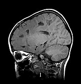 Vanishing White Matter Disease