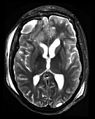 Traumatic Brain Injury MRI