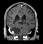 Cerebellar Hemangioblastoma MRI