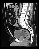Enlarged Prostate Gland on CT