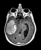 Atypical Meningioma on MRI