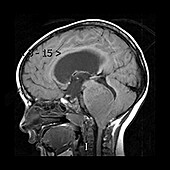 MRI of Pontine Glioma in Child