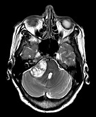 Large Vestibular Schwannoma MRI