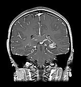 Temporal Lobe AVM with Haemorrhage in Child