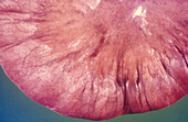 Pneumatosis intestinalis
