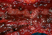 Ulcerative colitis