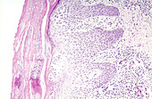 Subacute dermatitis, LM