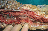 Crohn's Disease in Intestines