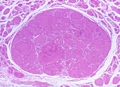 Benign Neoplasm of Thyroid Gland, LM