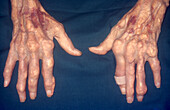 Severe Gout, Hands