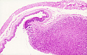 Gastro-Esophageal Junction, LM