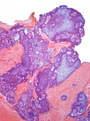 Salivary gland cancer, LM