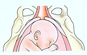 Foetus coming from an opening cervix, illustration