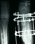 X-ray of leg fastened with metal supports
