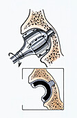 Hip socket for hip replacement, illustration