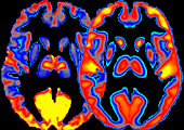 Effects of alcohol on the brain, PET and fMRI scan