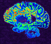 Multiple sclerosis, MRI scan