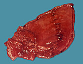 Gastric ulcer, gross specimen