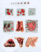 Stages and types of smallpox