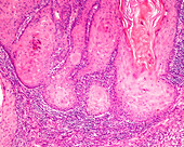 Actinic or senile keratosis, light micrograph