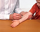 Doctor doing allergy prick test on boy's arm