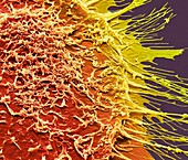 Vaginal cancer cells, SEM