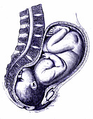 Child in birth position, 19th century illustration