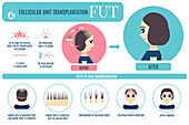 FUT hair transplantation in women, illustration
