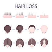 Male and female hair loss patterns, conceptual illustration