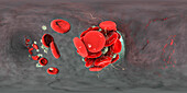 Blood clot, illustration