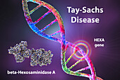 Tay-Sachs disease, illustration