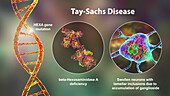 Tay-Sachs disease, illustration