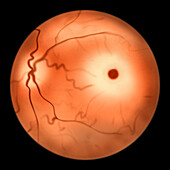 Eye retina in Tay-Sachs Disease, illustration