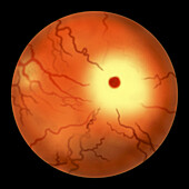 Eye retina in Tay-Sachs Disease, illustration