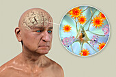 Infectious aetiology of dementia, illustration