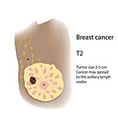 Female breast cancer T2, illustration