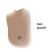 Vein growth in female breast, illustration