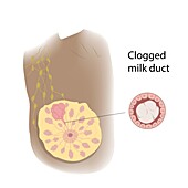 Clogged milk duct in female breast, illustration