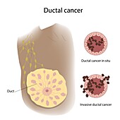Ductal cancer in female breast, illustration