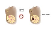 Clogged milk duct and breast cancer comparison, illustration