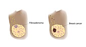 Fibroadenoma and breast cancer comparison, illustration