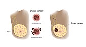 Ductal cancer and breast cancer comparison, illustration