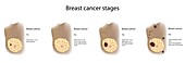 Female breast cancer stages, illustration