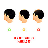 Female pattern hair loss, conceptual illustration