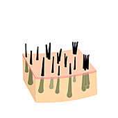 Hair micrograft types, conceptual illustration