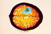 Coloured CT scan of brain with metastatic cancer