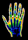 X-ray image of a boy's hand